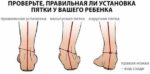 Вальгусная деформация стопы представляет собой